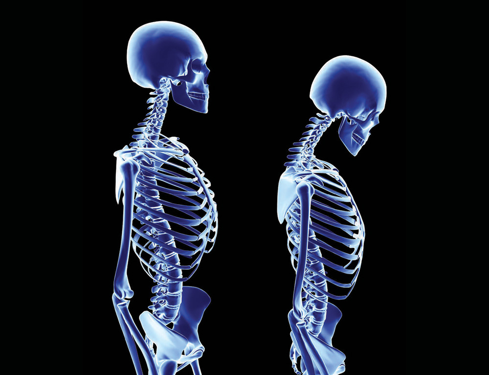 EARLY EVALUATION OF BONES FIGHTS THE OSTEOPOROSIS