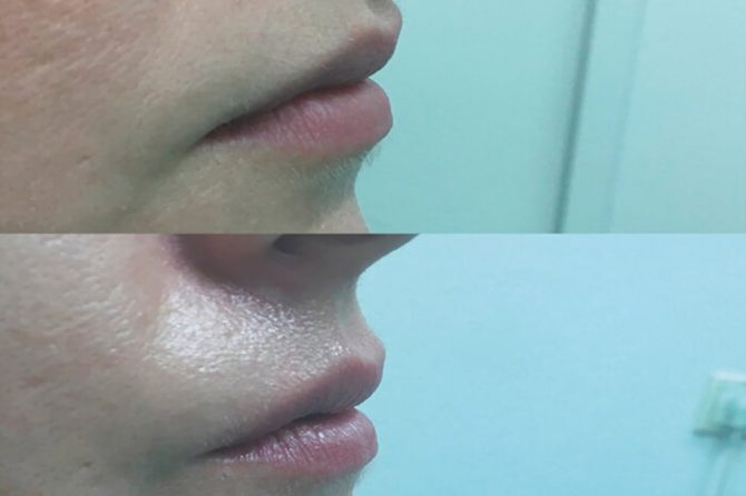Lip augmentation: new rejuvenation with Er:YAG and Nd:YAG laser